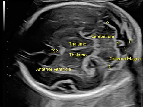 normal cisterna magna fetal ultrasound.